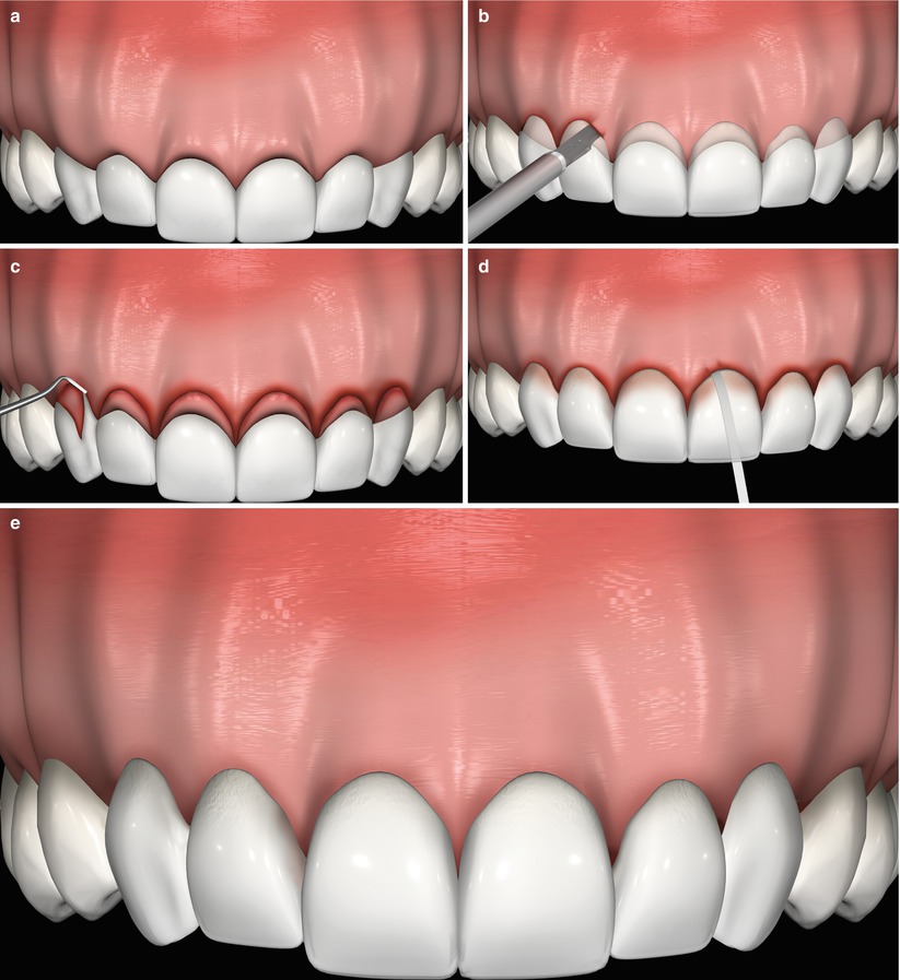 Crown Lengtething Phoenix