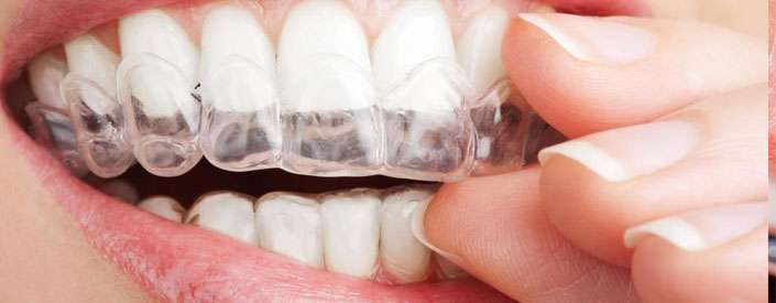 Teeth Whitening Phoenix