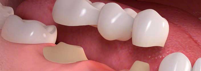 affordable-dental-bridge-85014
