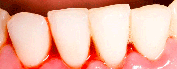 gum disease phoenix