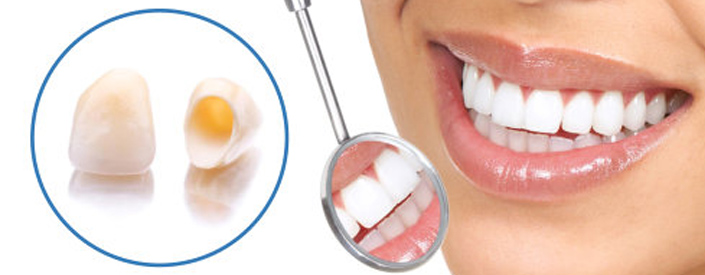 Dental Crowns Phoenix
