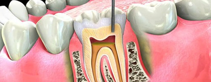 root-canal-phoenix-85014-features