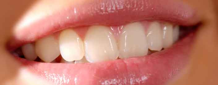 Dental Bonding Phoenix