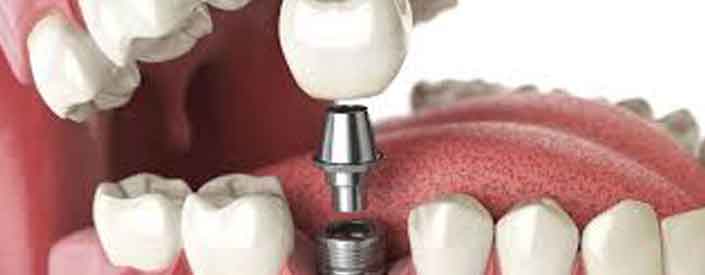dental implants 85014