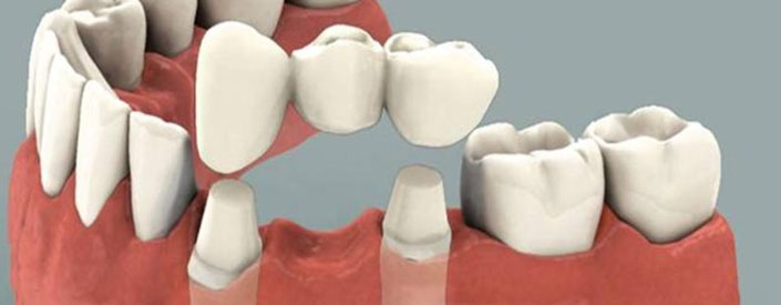dental-bridge-clean-phoenix