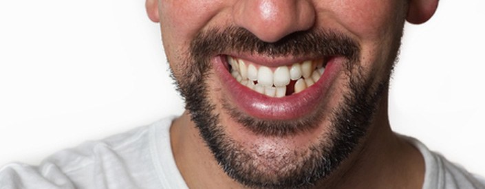 missing-teeth-solution