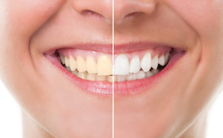 teeth-whitening-phoenix