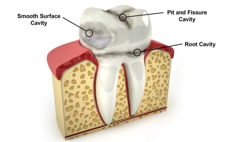 How Dental Cavities Are ClassifiedHow Dental Cavities Are Classified