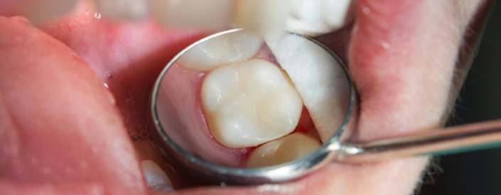 cavity-repair-phoenix