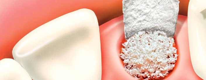 bone-graft-phoenix-dental-implant
