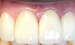 Procedures: Same Day Implants