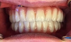 Procedures:Full Smile Reconstruction