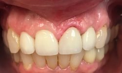 Procedures: Same Day Crown to close the gaps
