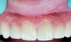 Procedures: Root Canals, Same Day Crowns, & Full Upper Rehab