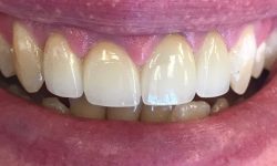 Procedures: Same Day Crown Treatment